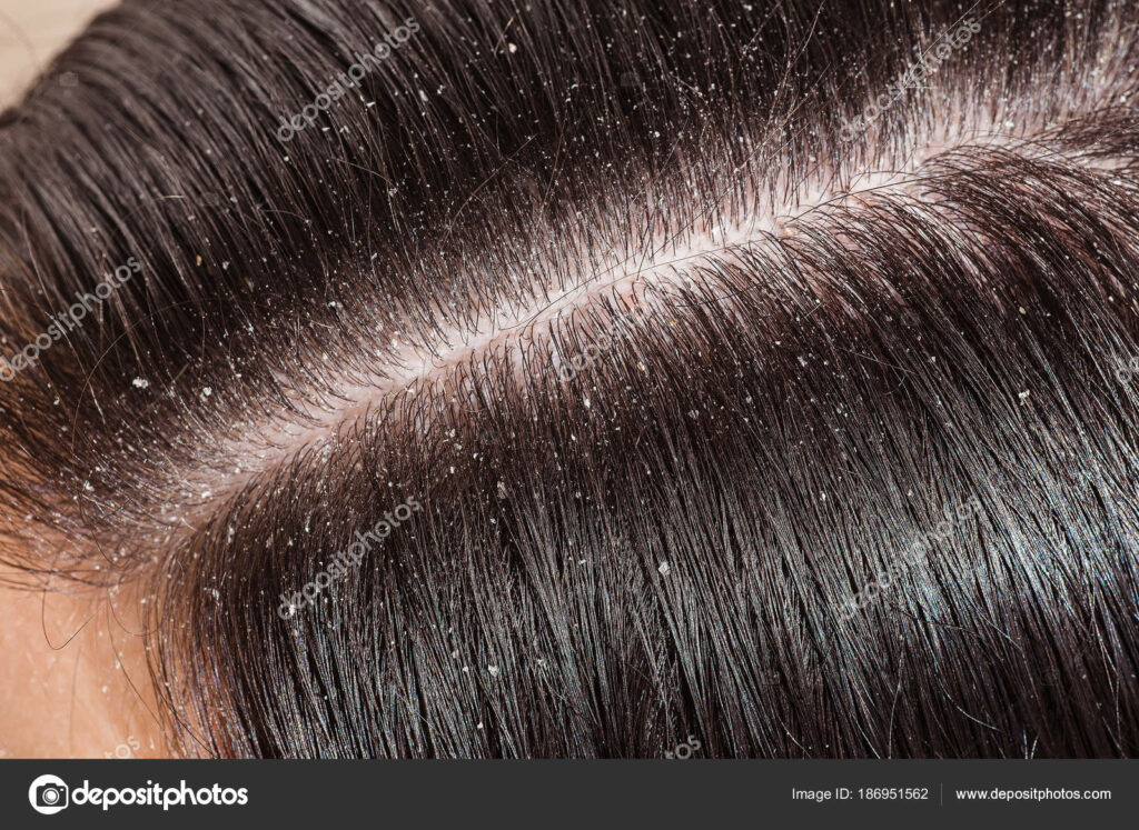 Comment traiter les pellicules